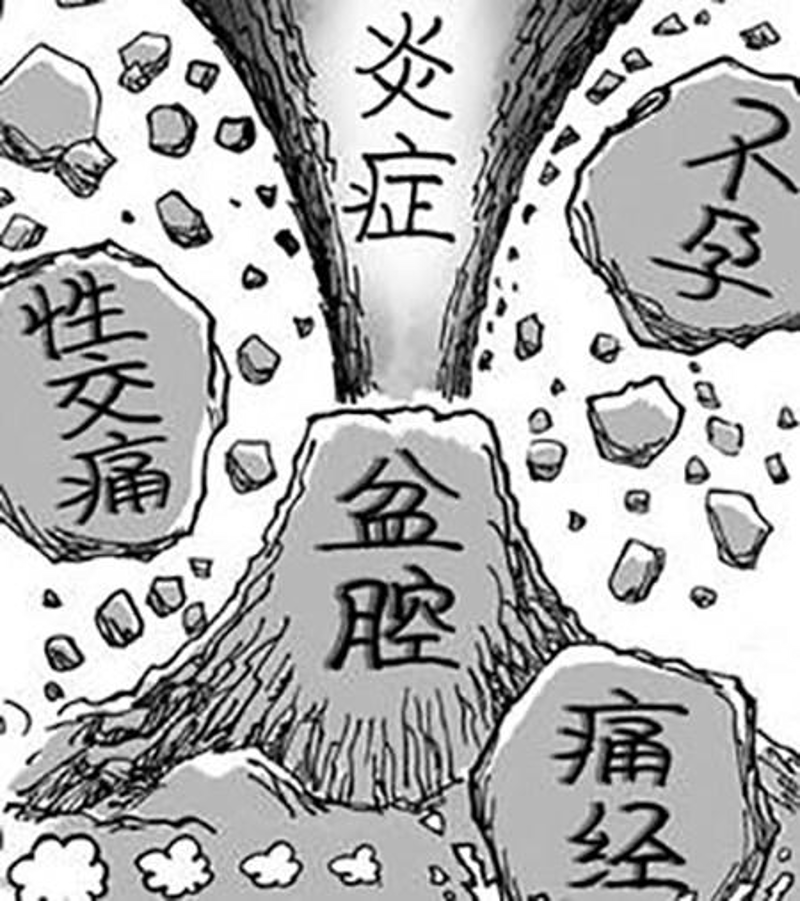 盆腔炎
